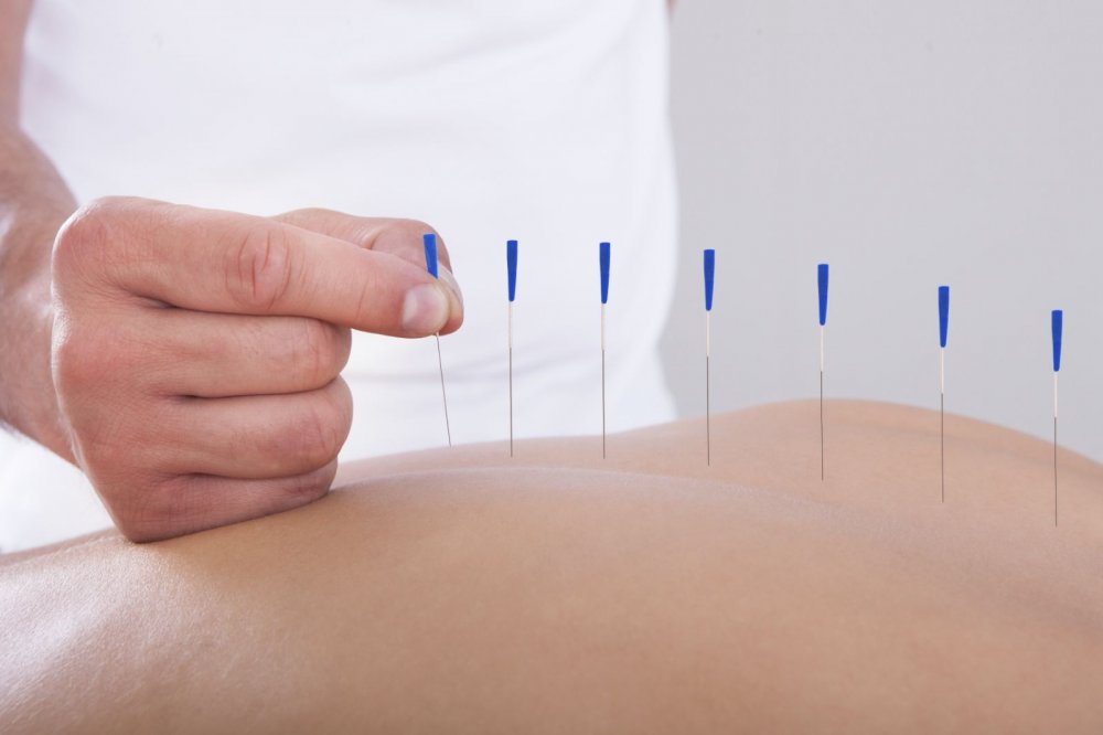 Na co pomáhá akupunktura?