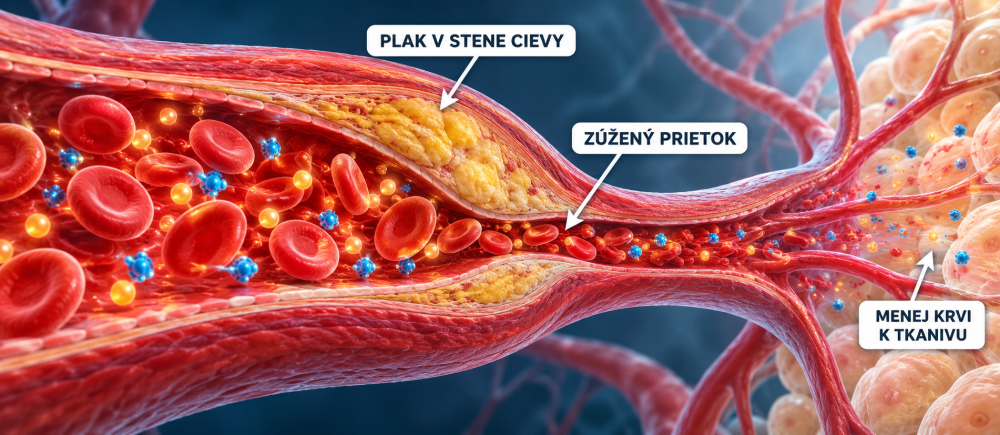 Průřez tepnou se žlutým aterosklerotickým plátem ve stěně a zúženým prostorem pro průtok krve.
