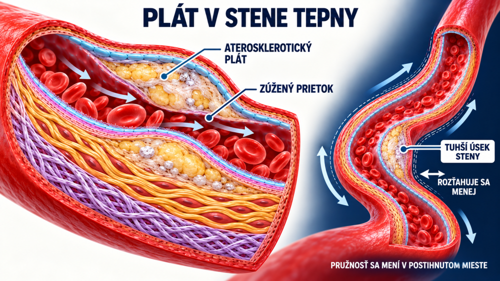 Schéma plátu ve stěně tepny